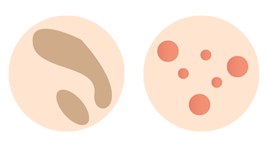 Skin Discolouration Skin Discolouration