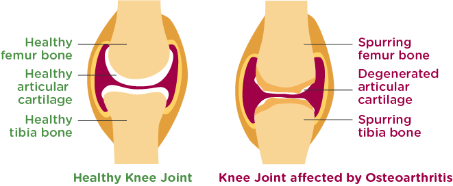 Heathy Knee Joint VS. Knee Joint Affected by Osteoarthritis